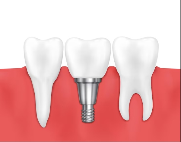 Care sunt beneficiile implantului dentar?